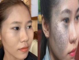 NHẬT KÍ ĐIỀU TRỊ BỚT SẮC TỐ CỦA KHÁCH HÀNG TẠI THẨM MỸ VIỆN TRÚC MAI