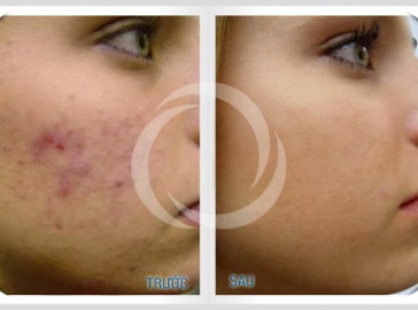 ĐIỀU TRỊ DA MỤN