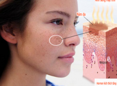 ĐIỀU TRỊ DA NÁM