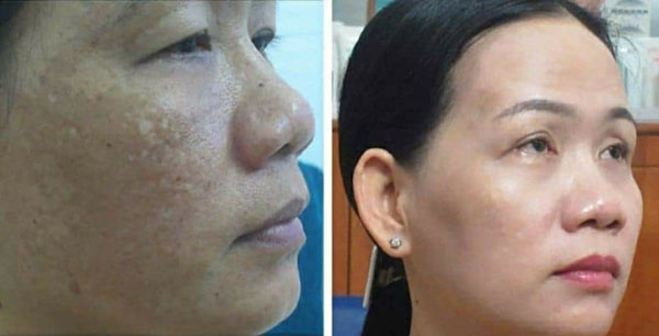 kết quả điều trị da nám tại thẩm mỹ viện Trúc Mai - 093 937 4003