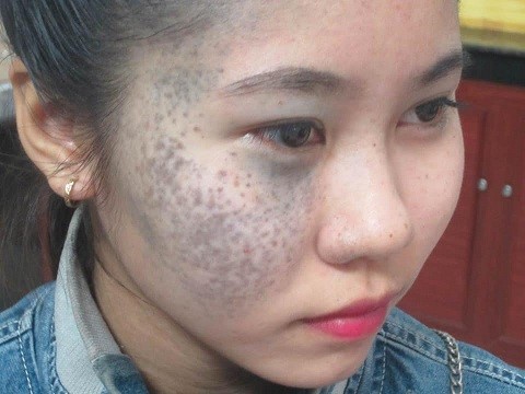 nhật ký điều trị bớt sắc tố tại thẩm mỹ viện trúc mai - 093 937 4003