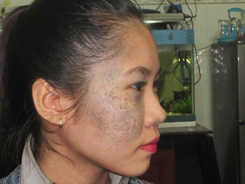 nhật ký điều trị bớt sắc tố tại thẩm mỹ viện trúc mai - 093 937 4003