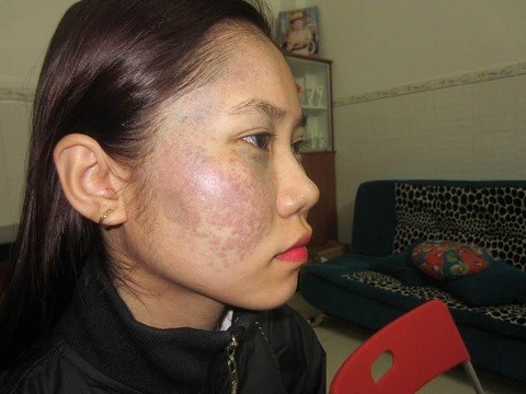 nhật ký điều trị bớt sắc tố tại thẩm mỹ viện trúc mai - 093 937 4003