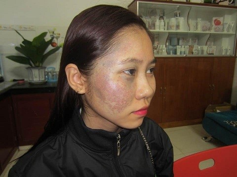 nhật ký điều trị bớt sắc tố tại thẩm mỹ viện trúc mai - 093 937 4003