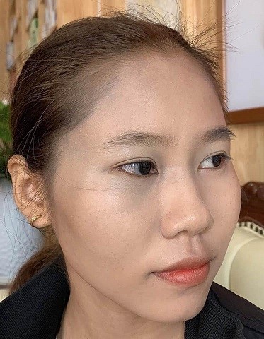 nhật ký điều trị bớt sắc tố tại thẩm mỹ viện trúc mai - 093 937 4003