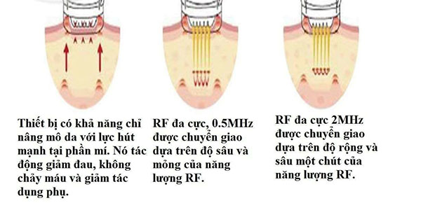 trẻ hóa vùng mắt bằng công nghệ rf benefits