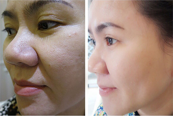 Trước và sau khi sử dụng liệu trình công nghệ chân không - Vi điểm RF kết hợp Vitamin làm trẻ hóa da- Trước và sau khi sử dụng liệu trình công nghệ chân không - Vi điểm RF kết hợp Vitamin làm trẻ hóa da