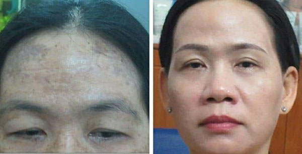 kết quả điều trị da nám tại thẩm mỹ viện Trúc Mai - 093 937 4003