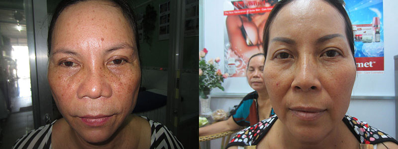 trước và sau điều trị trẻ hóa da - https://thammyvientrucmai.com/