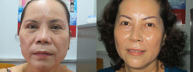 điều trị trẻ hóa da tại thẩm mỹ trúc mai vĩnh long - https://thammyvientrucmai.com/