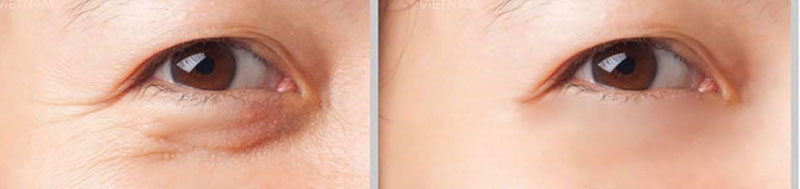 trước và sau điều trị trẻ hóa vùng mắt - https://thammyvientrucmai.com/